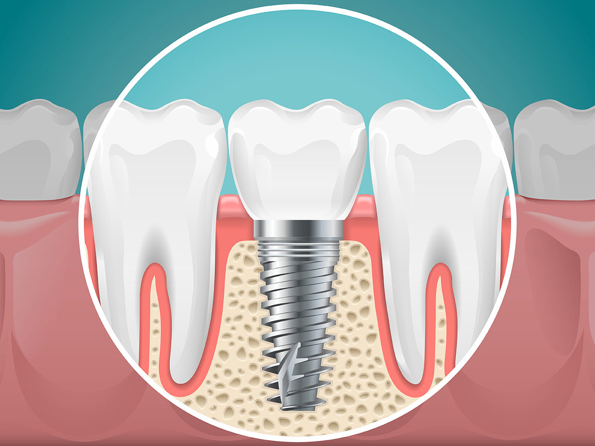 Dental Implants
