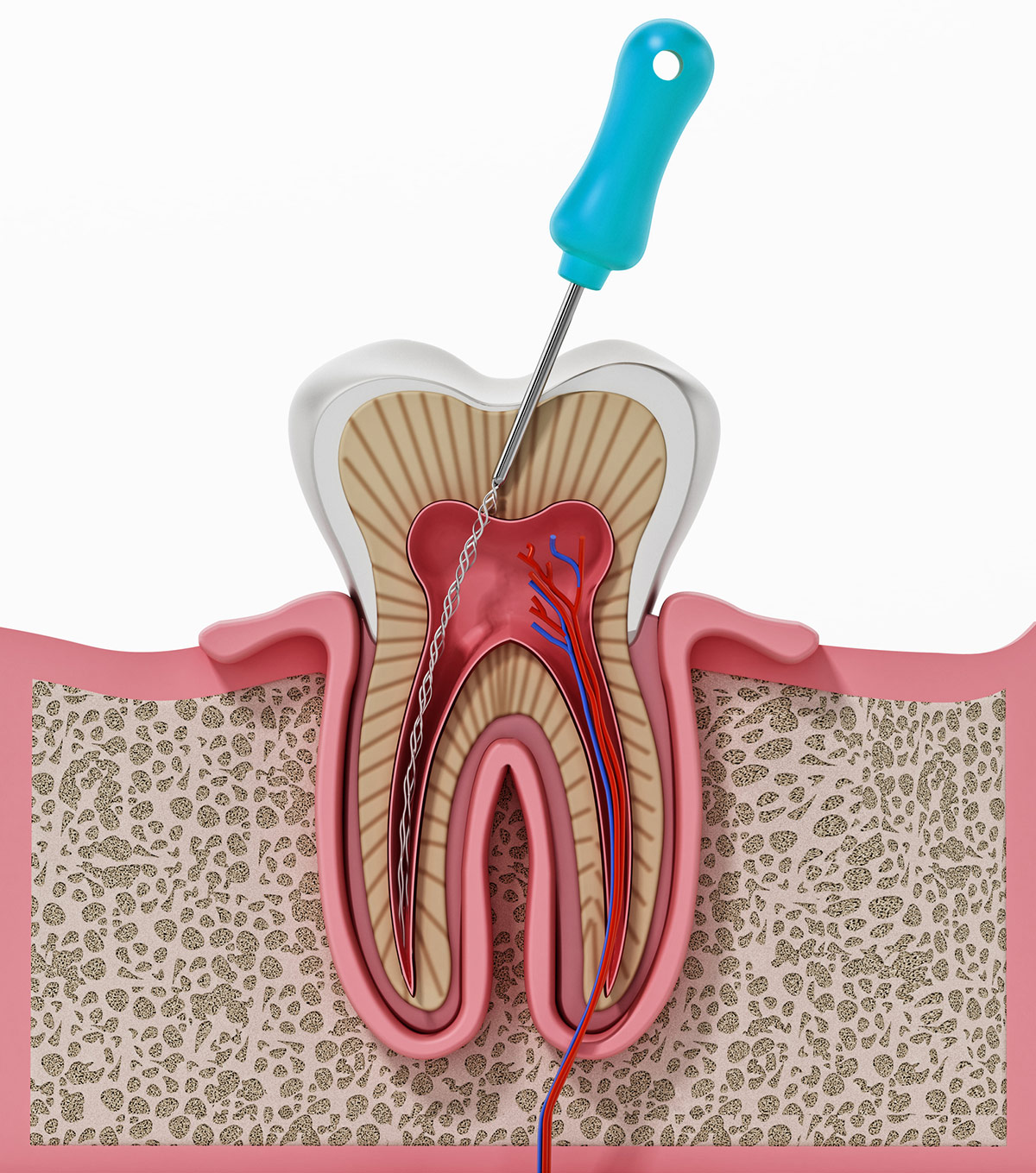 Root Canal Richmond